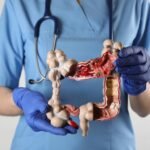 Colon Cancer Surgery in Delhi – By Dr. Deep Goel