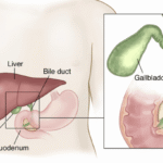 Is Bile Duct Cancer Lurking Within? Understand Its Signs and Treatments